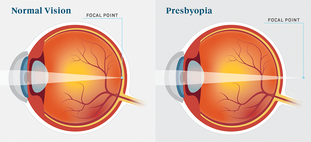 Why Do People Wear Reading Glasses?